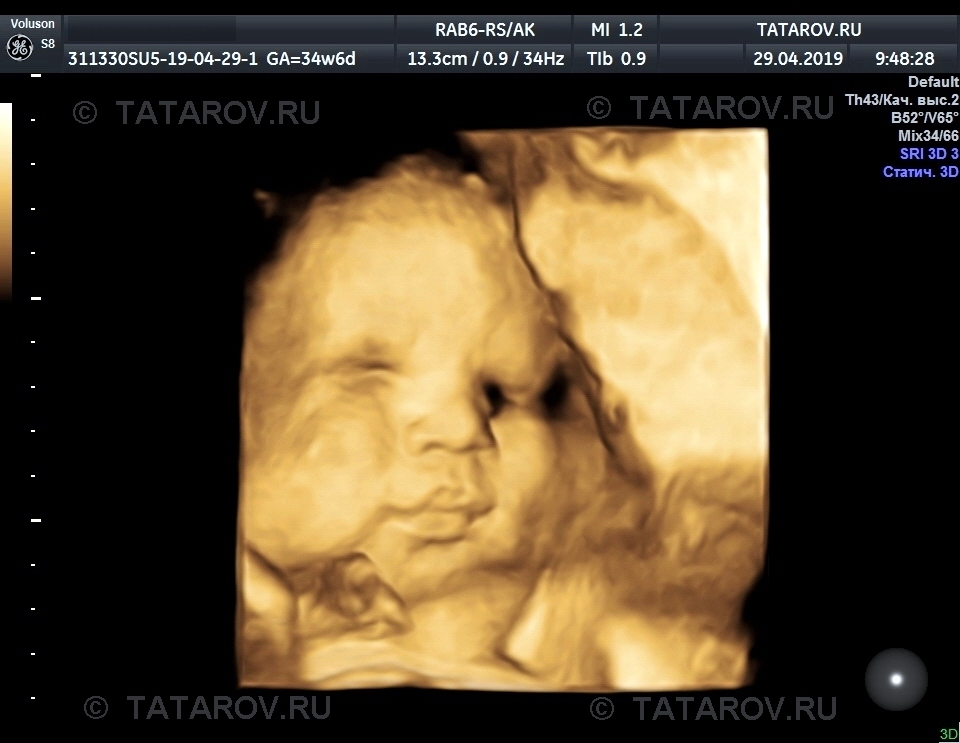 3D и 4D УЗИ при беременности в Москве: цены, фото - клиника REMEDI